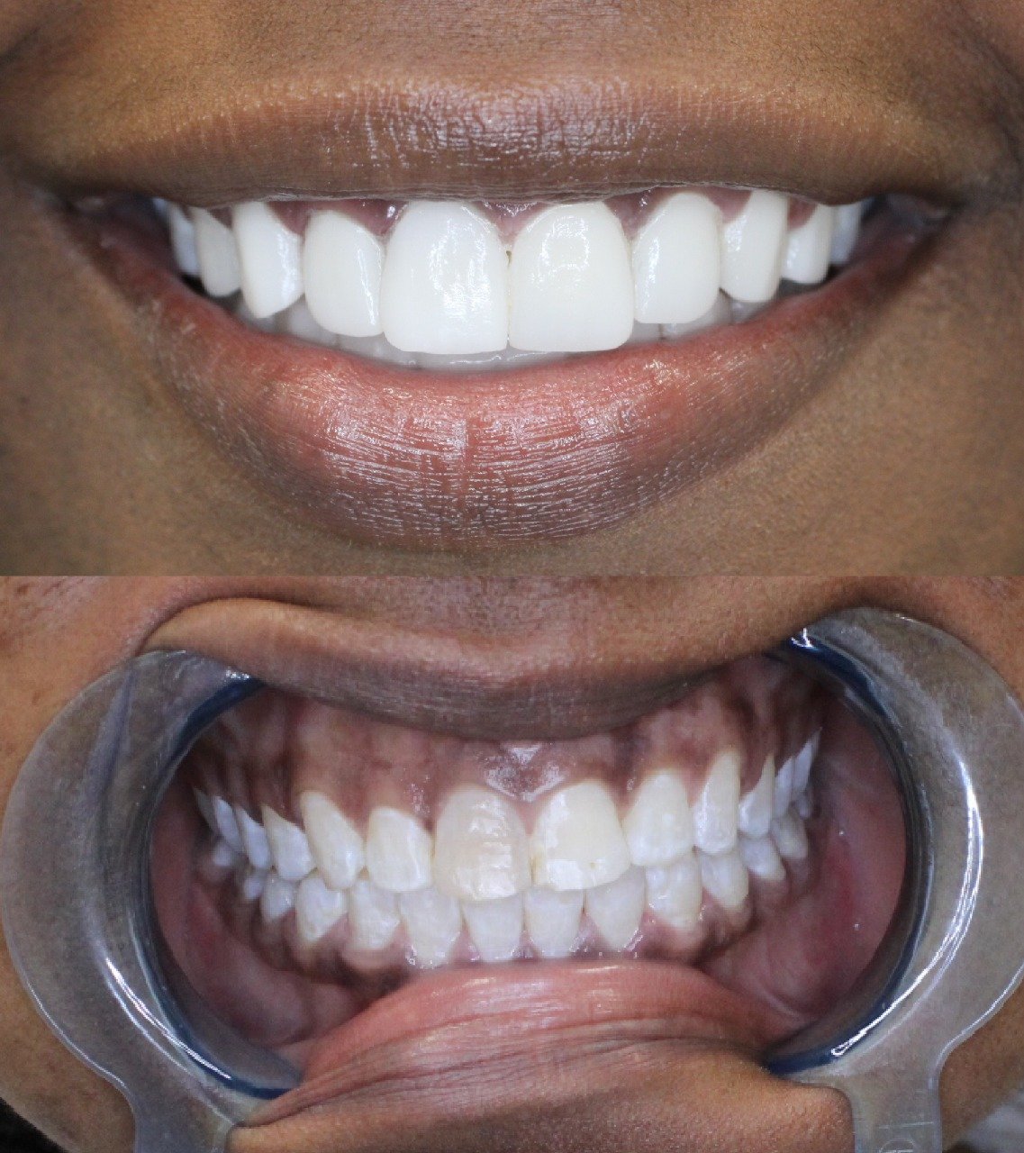 Veneers in Miami Dentist in Miami, FL The Smile Mission