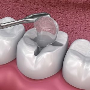 dental fillings 300x300 1