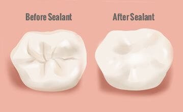dental sealants1