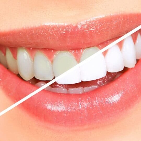 teeth whitening 1 1536x962 1