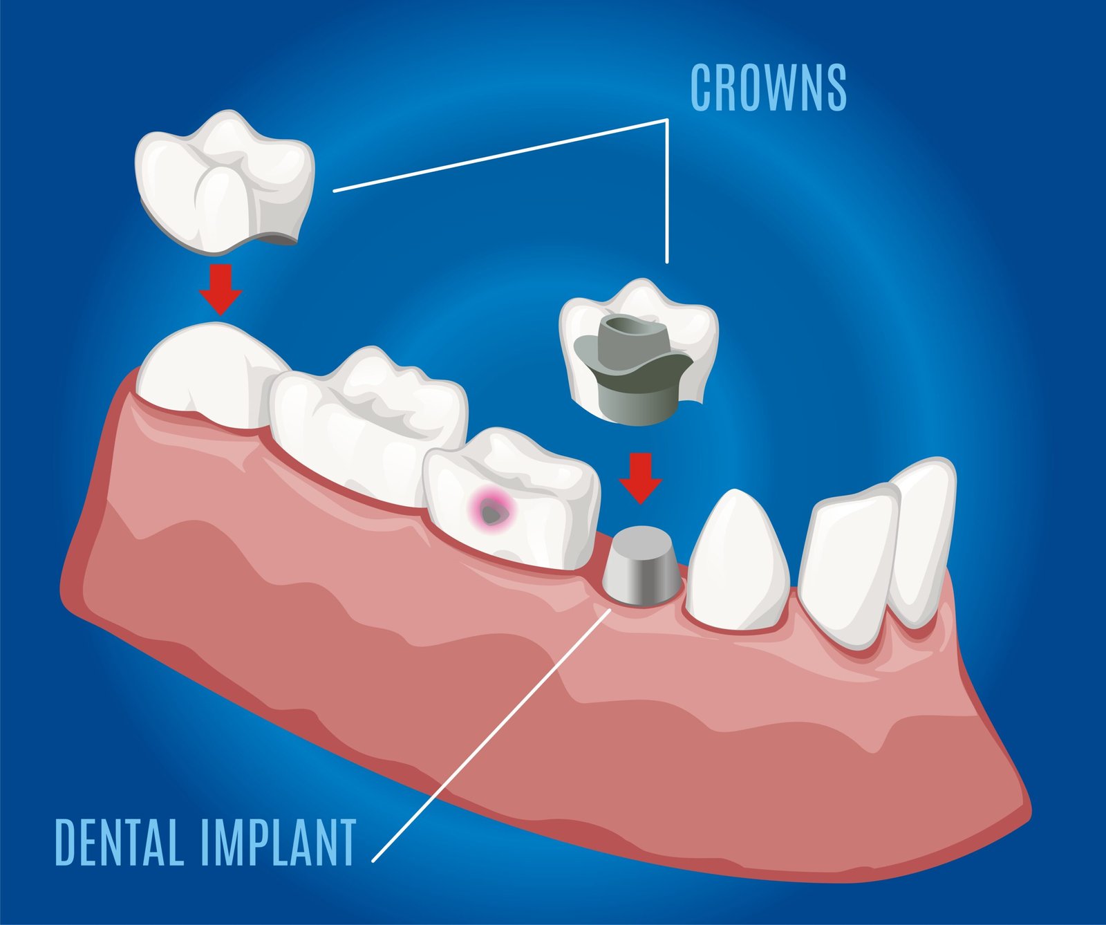 Do you have lost teeth? - The Smile Mission