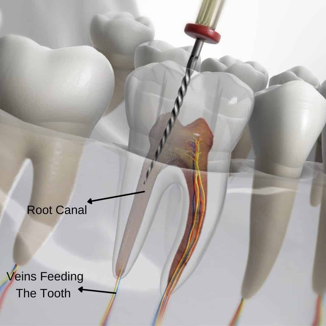 rootcanaltreatment.jpeg