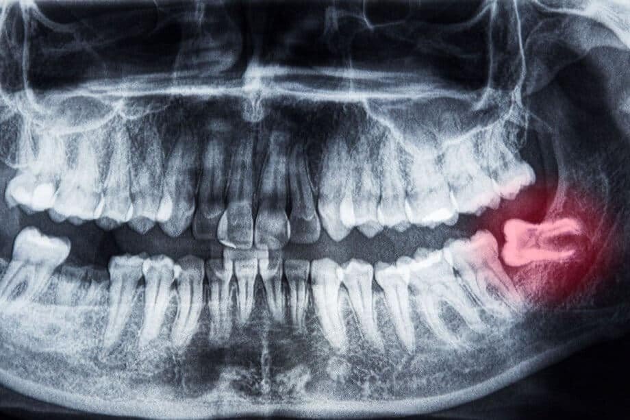dental-x-ray-of-wisdom-tooth-920x613-1.jpg