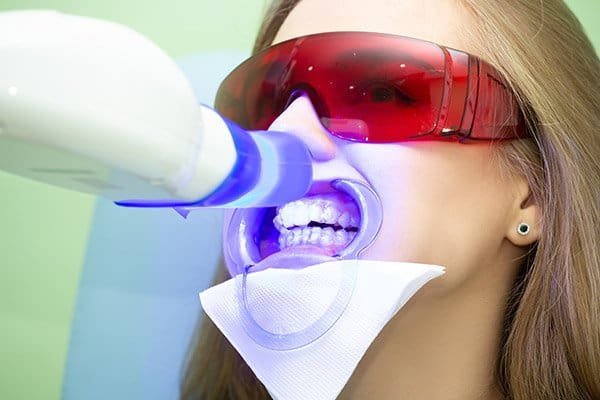 laser-teeth-whitening-and-possible-effects-on-gums.jpg