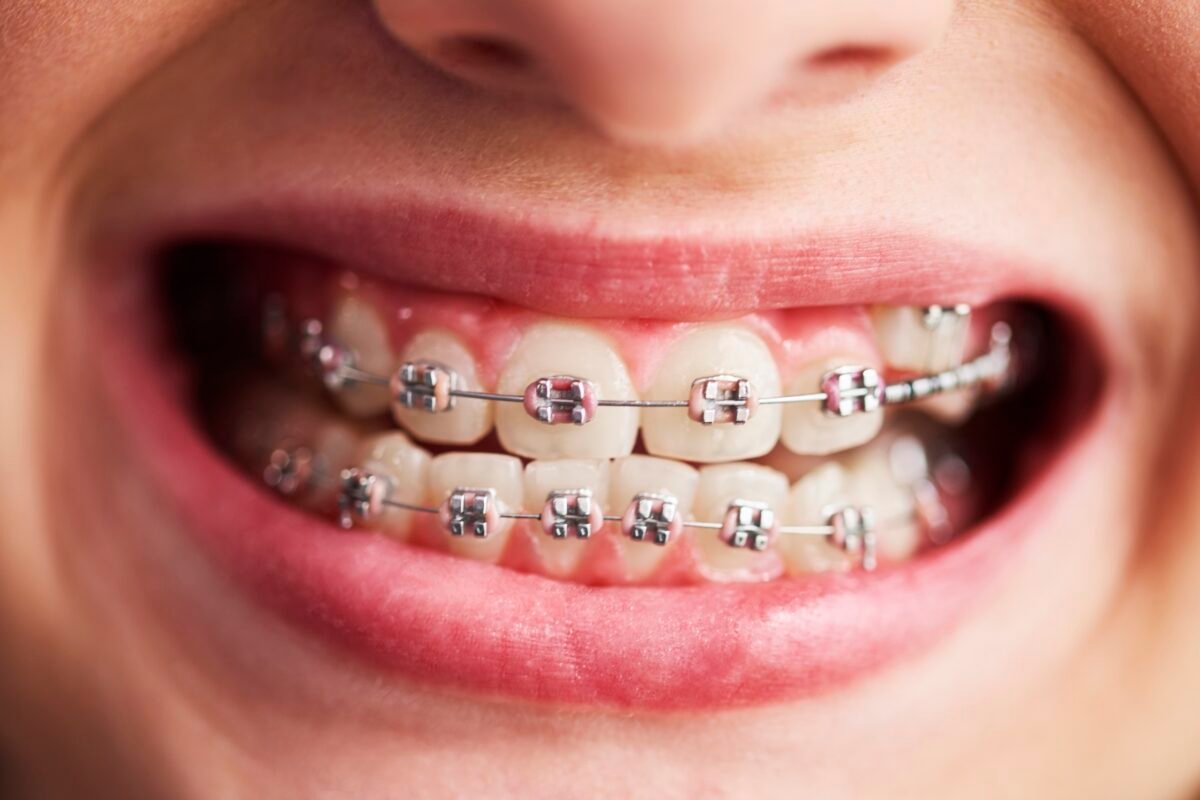 Braces-in-Miami-1-1200x800.jpg