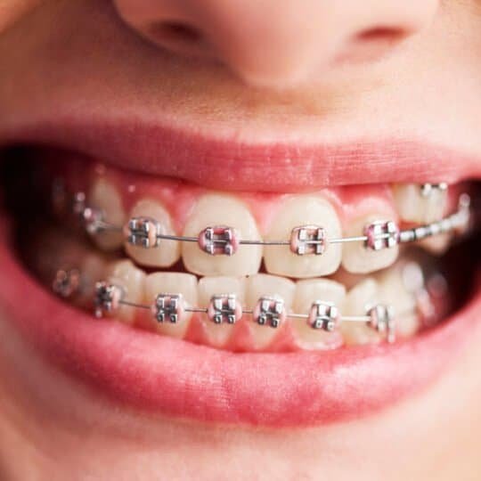 Braces in Miami Braces in Miami