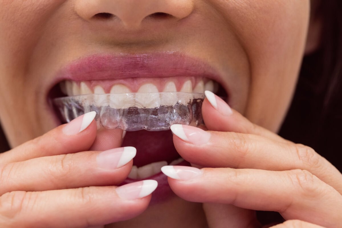 Same-day-aligners-work-1200x800.jpg