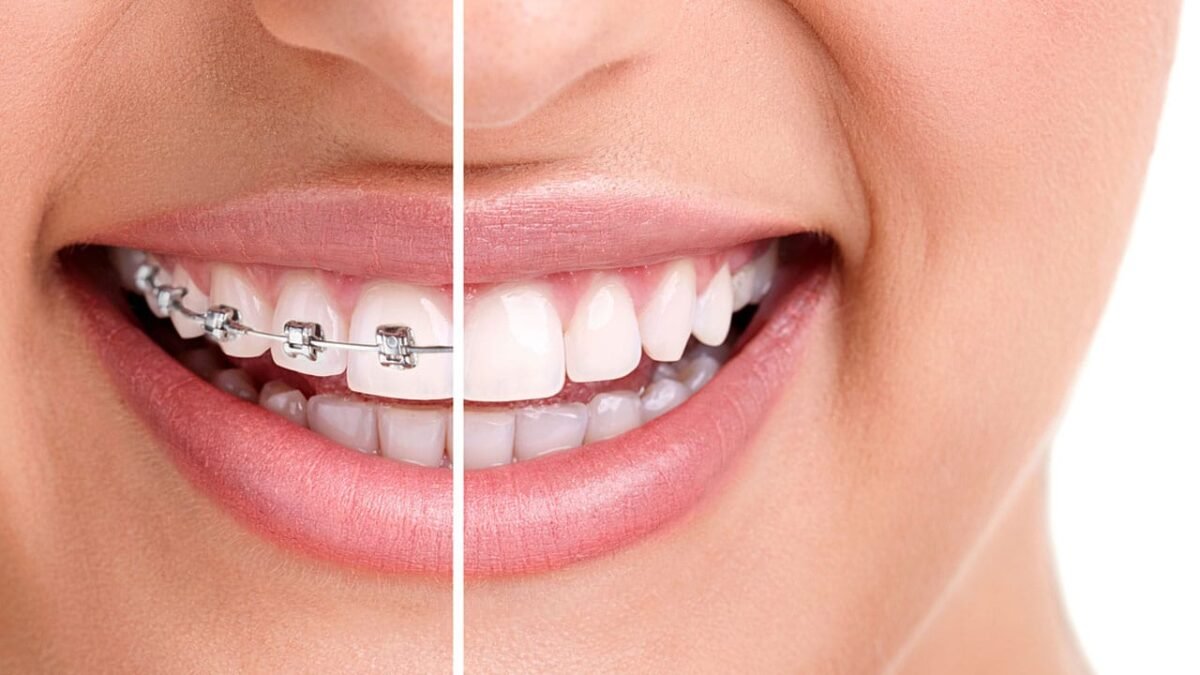 braces-before-after-min-1200x675.jpg
