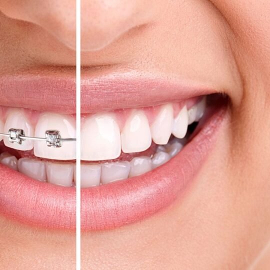 braces before after min braces before after min