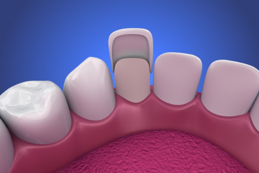 Veneers900x600.jpg