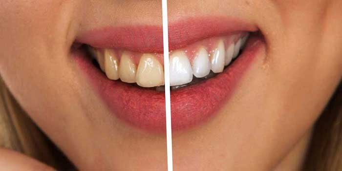 tooth-bleaching-at-rajkot.jpg