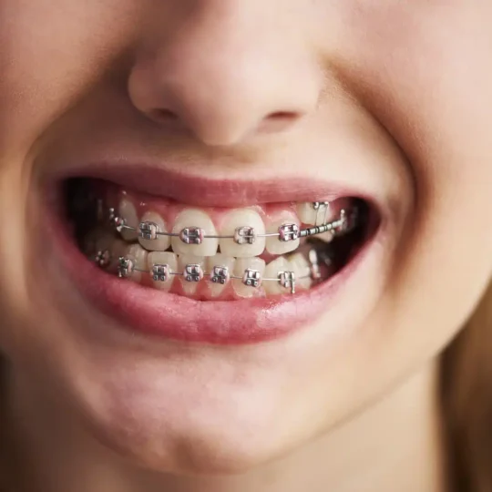 shot teeth with braces shot teeth with braces