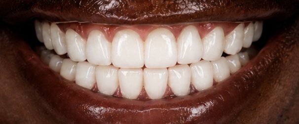 Basic Veneers