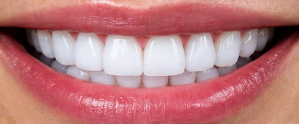 Composite Veneers