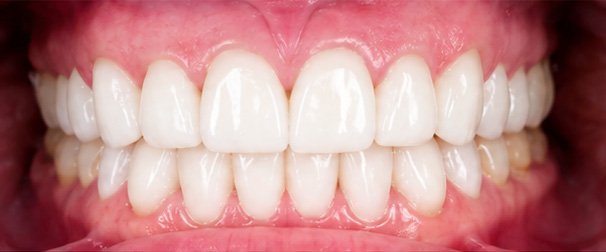 Premium Veneers