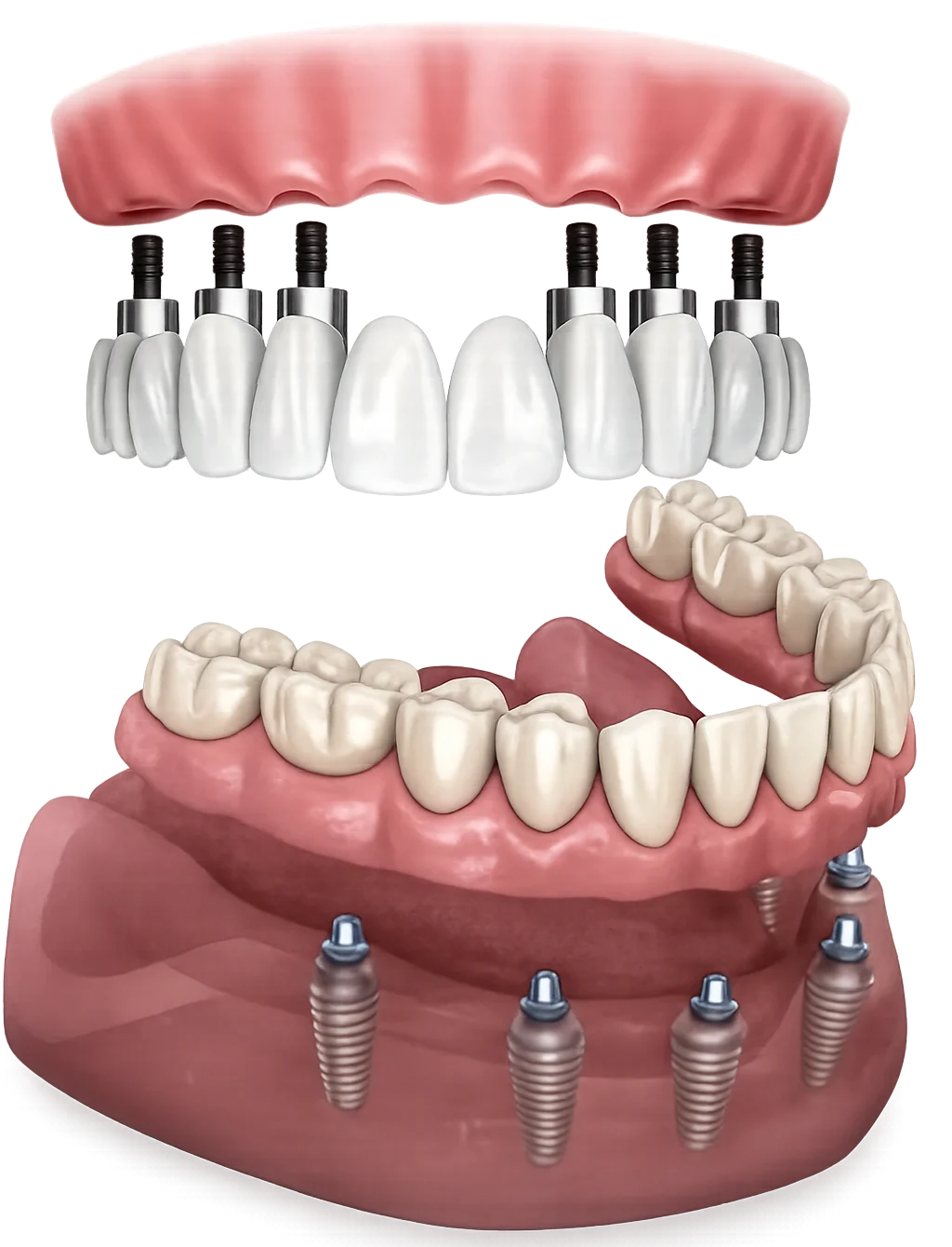 Dental Implant Options