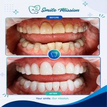 before-after1