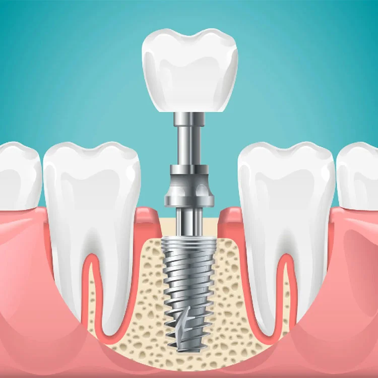 dental implants clinic hyderabad bangalore